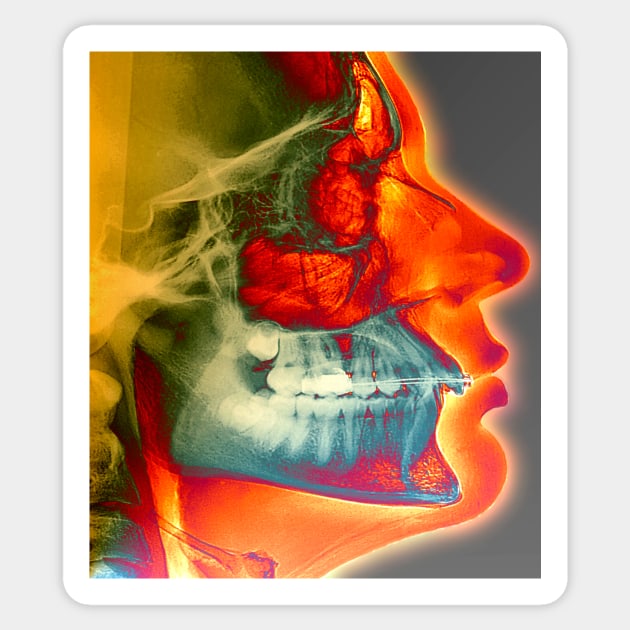 Orthodontic brace X-ray (M780/0342) Sticker by SciencePhoto